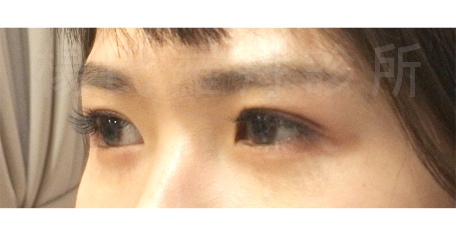 楊氏羅丹,雙眼皮,醫學美容