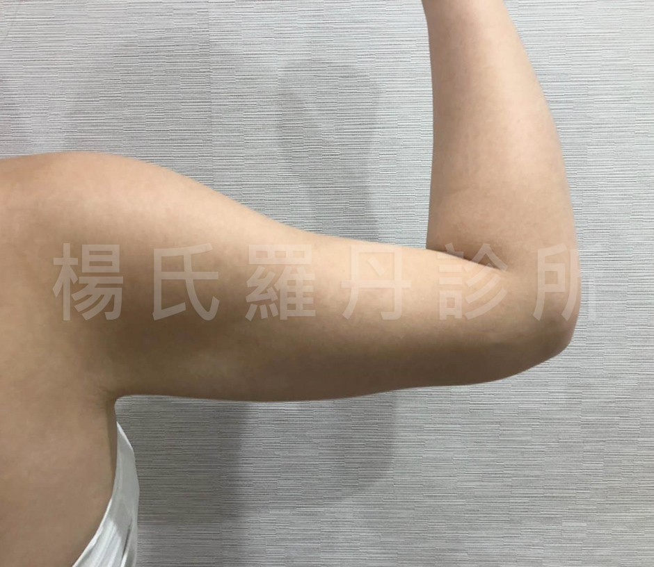 楊氏羅丹,瘦手臂 蝴蝶袖