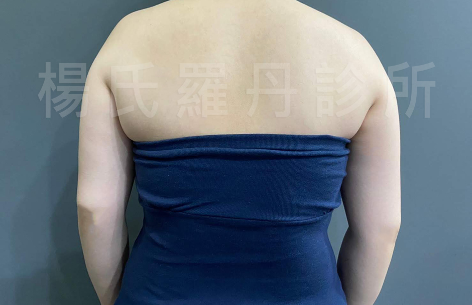楊氏羅丹 雷射減脂 瘦手臂 手臂 蝴蝶袖
