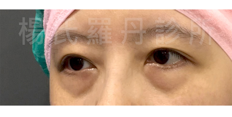 眼袋,淚溝,自體脂肪,楊氏羅丹