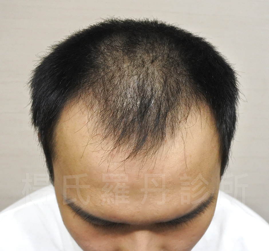 禿頭,掉髮,M字型禿