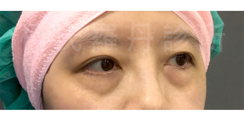 眼袋,淚溝,自體脂肪