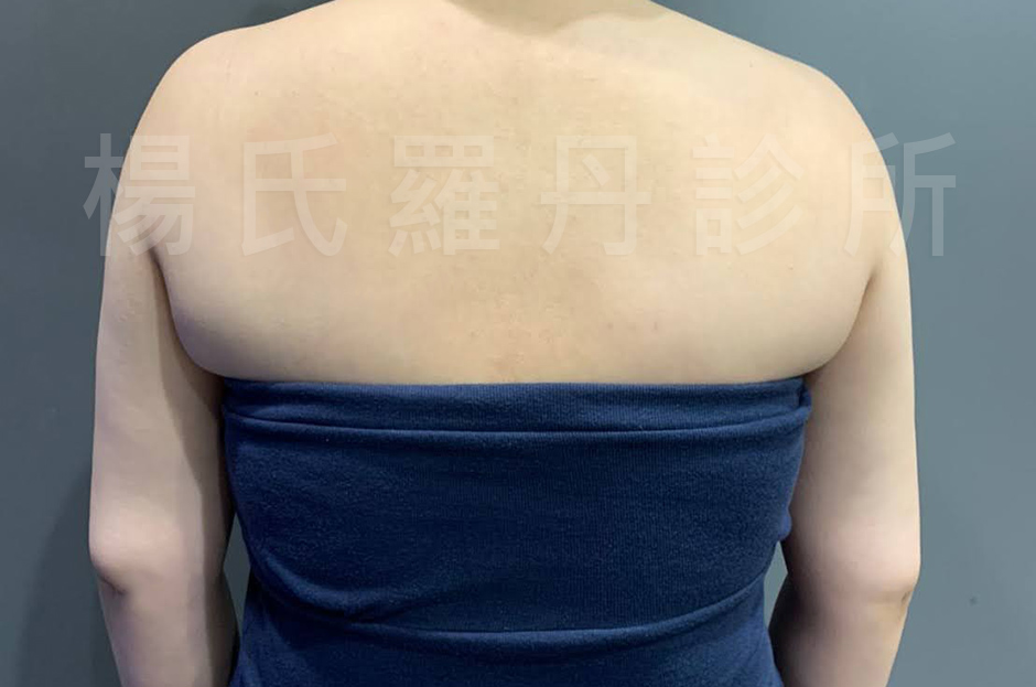 楊氏羅丹,瘦手臂,手臂 雷射減脂