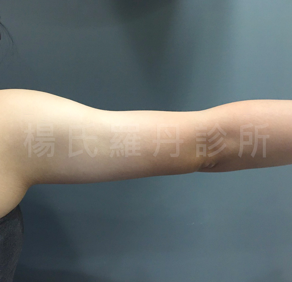 蝴蝶袖,楊氏羅丹 雷射減脂 瘦手臂