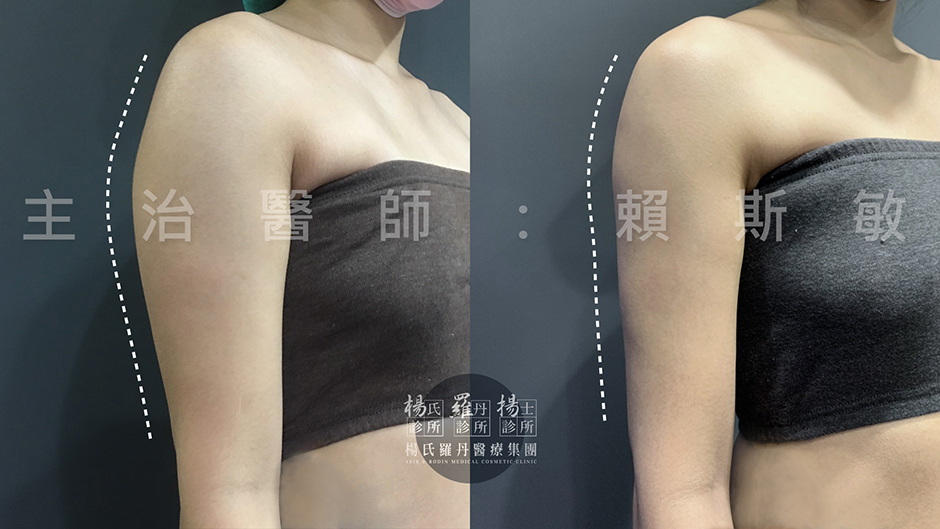 雕塑手臂  雷射減脂  蝴蝶袖  贅肉