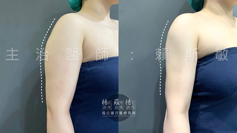 手臂  贅肉 楊氏羅丹,瘦手臂,雷射減脂,
