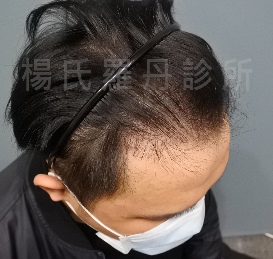 雄性禿,禿頭,植髮,掉髮