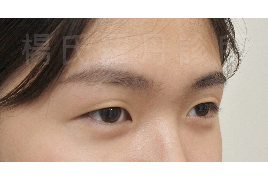 雙眼皮,單眼皮,韓式雙眼皮