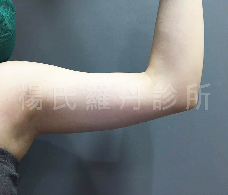雷射減脂,蝴蝶袖,手臂,贅肉