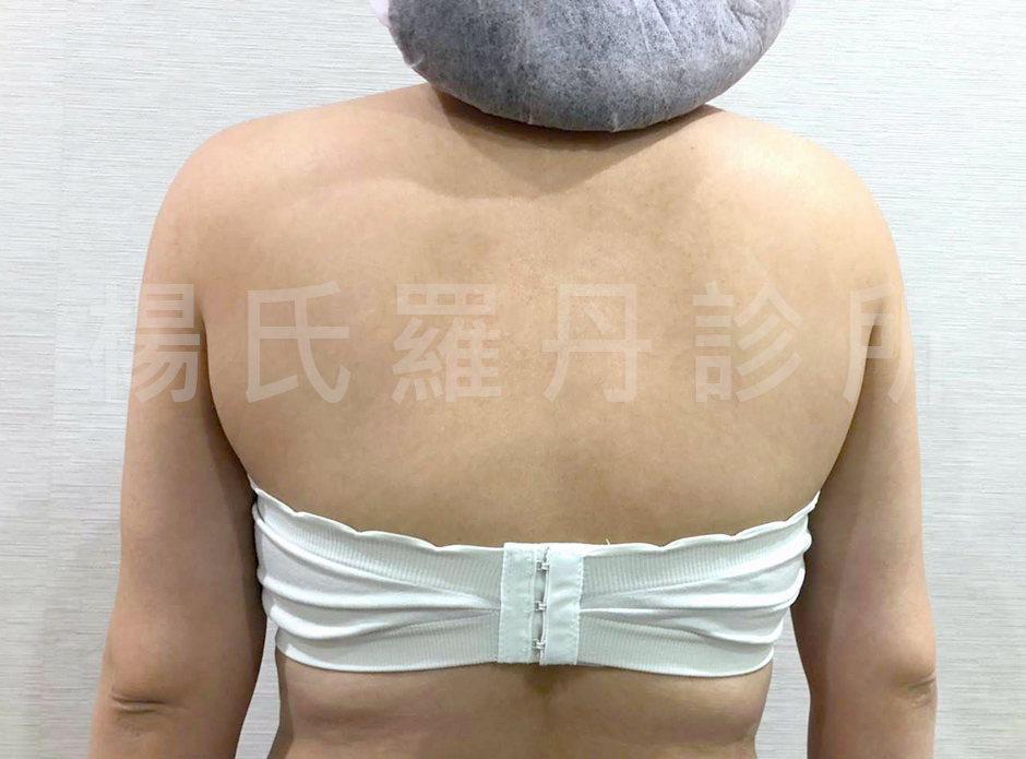 手臂,雷射減脂,楊氏羅丹 贅肉