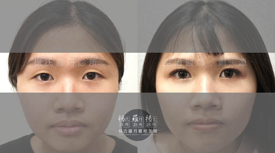 電眼,醫學美容,雙眼皮,單眼皮
