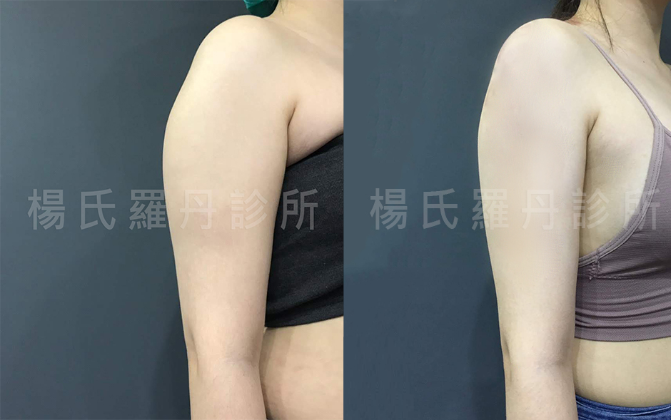 蝴蝶袖,手臂,楊氏羅丹 雷射減脂
