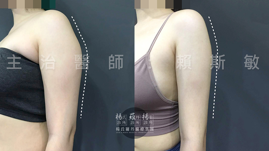 雷射減脂,楊氏羅丹,手臂 贅肉 瘦手臂