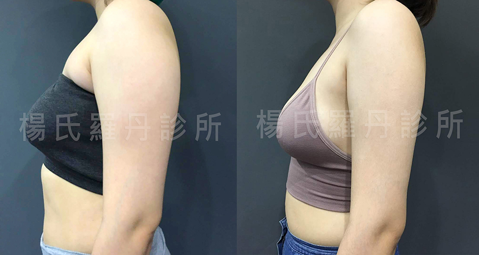 雷射減脂,贅肉,楊氏羅丹,瘦手臂