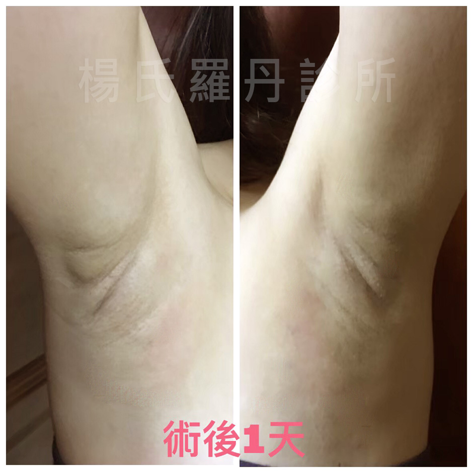 楊氏羅丹,除毛,止汗,狐臭