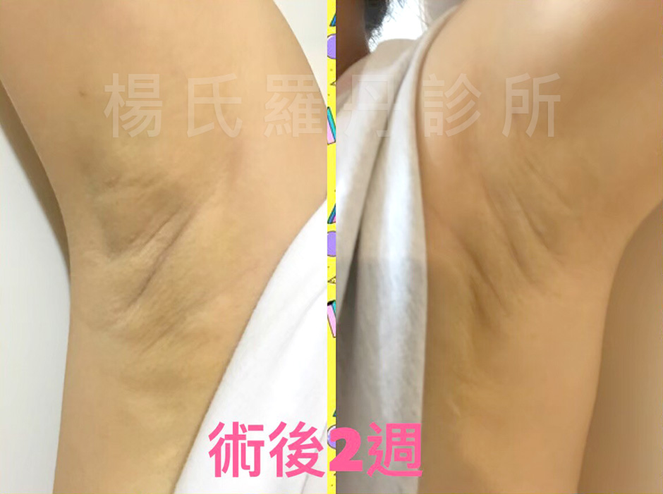 楊氏羅丹,除毛,止汗,狐臭,雷射除毛