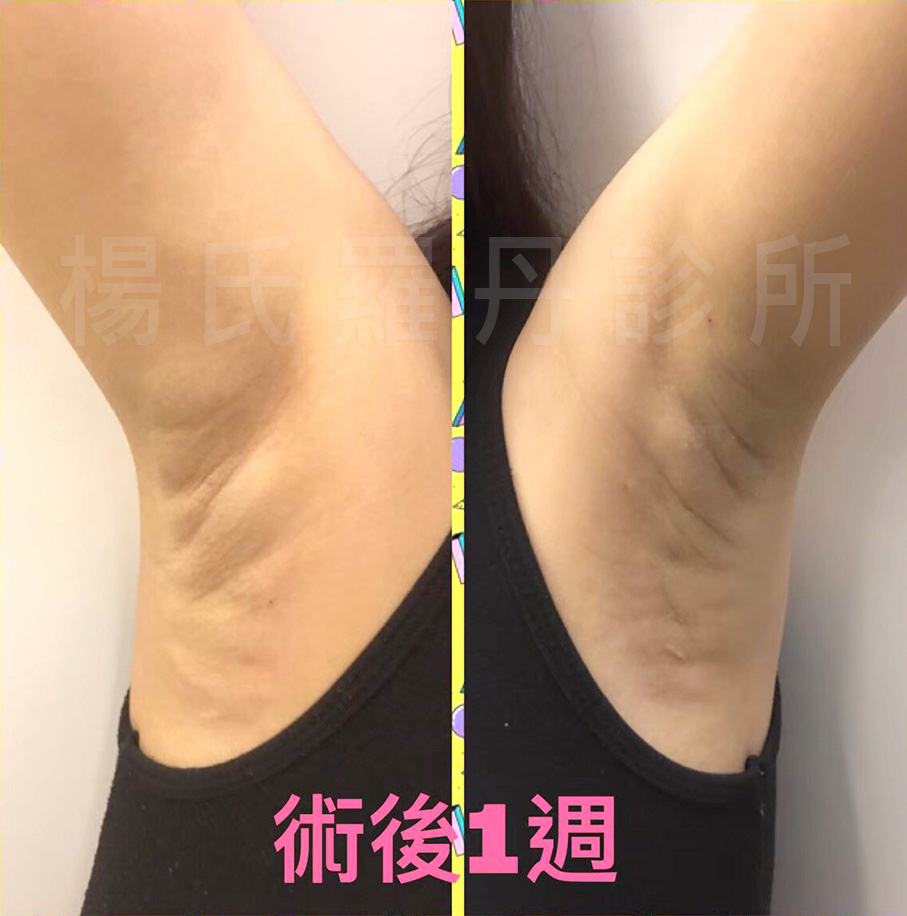 楊氏羅丹,除毛,止汗,狐臭,楊名錦