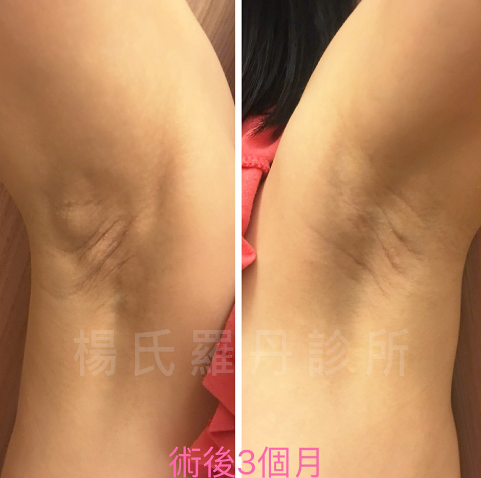 楊氏羅丹,除毛,止汗,狐臭,體味改善