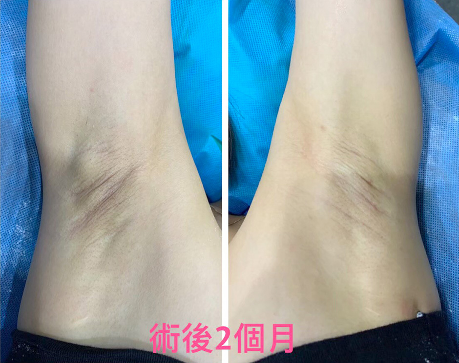 楊氏羅丹,除毛,止汗,狐臭