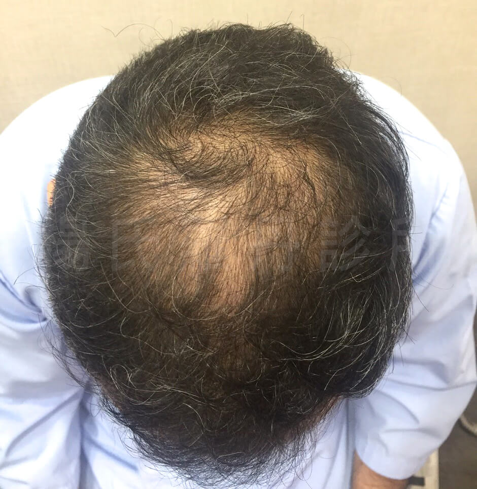 羅丹,楊名權,複合式植髮,落髮,生髮,複合式生髮,禿頭