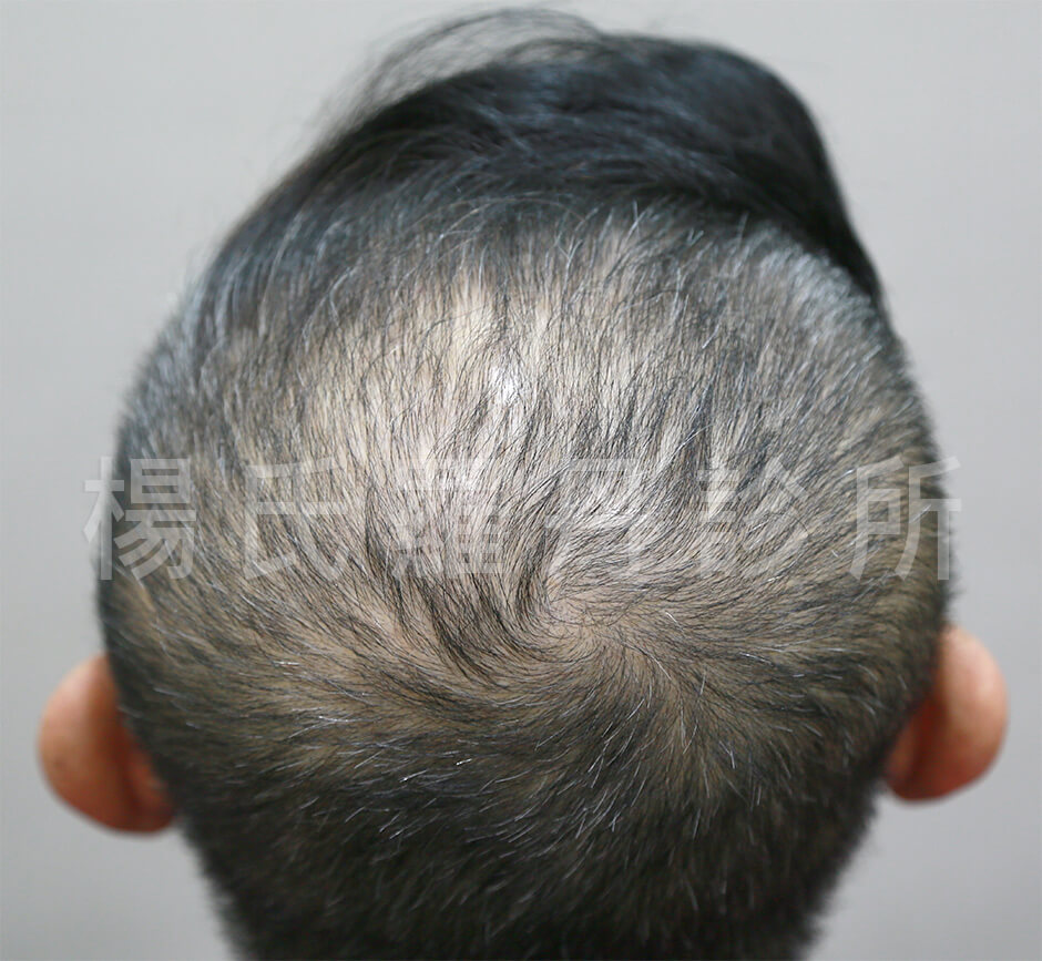 許效舜,植髮,生髮,養髮,落髮,圓禿,掉髮,複合式生髮,楊名權,楊氏羅丹,羅丹植髮,台北植髮