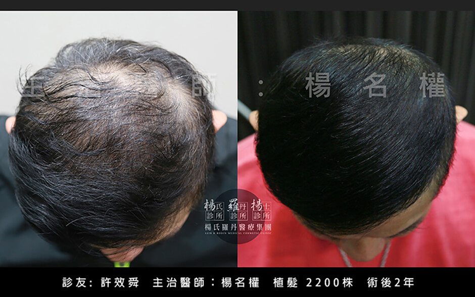 許效舜,植髮,生髮,養髮,落髮,圓禿,掉髮,複合式生髮,楊名權,楊氏羅丹,羅丹植髮,台北植髮