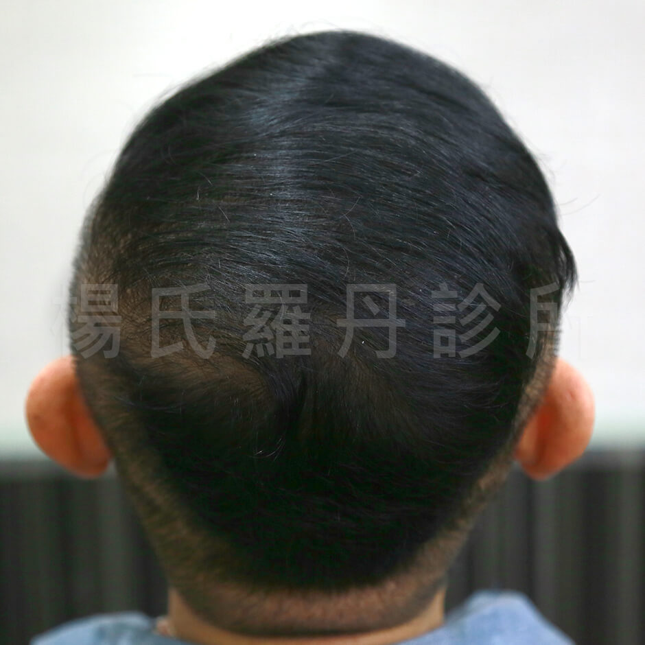 許效舜,植髮,生髮,養髮,落髮,圓禿,掉髮,複合式生髮,楊名權,楊氏羅丹,羅丹植髮,台北植髮