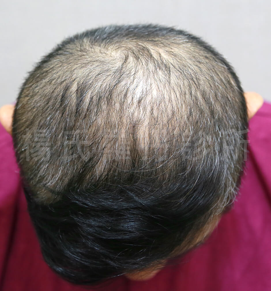 許效舜,植髮,生髮,養髮,落髮,圓禿,掉髮,複合式生髮,楊名權,楊氏羅丹,羅丹植髮,台北植髮