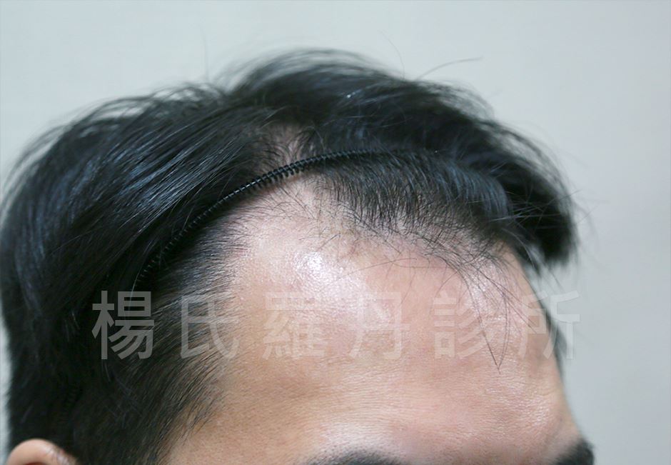小羊菌,楊氏羅丹,植髮,落髮,禿頭,楊名權