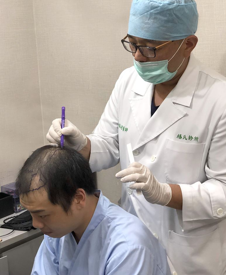 植髮,複合式生髮,阿虎,楊名權,楊氏羅丹,楊氏診所,掉髮,落髮,雄性禿,圓禿,異常落髮