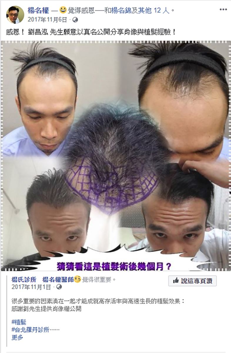 植髮,生髮,禿髮,楊氏羅丹