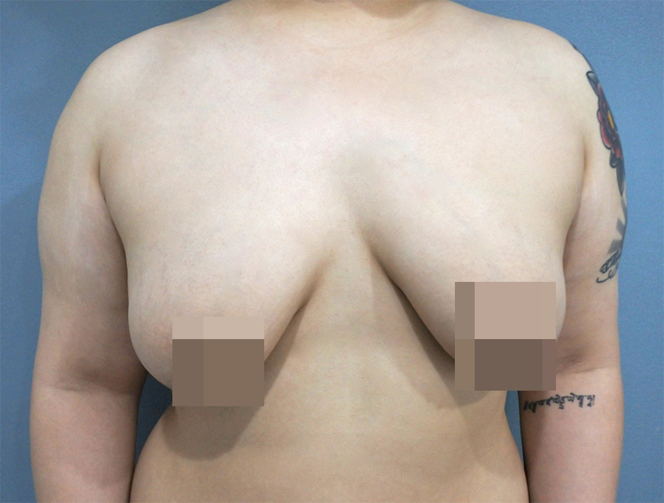 平胸手術,縮胸,楊氏羅丹,楊氏診所,台中羅丹,詹永璨醫師,醫美,胸部整形5