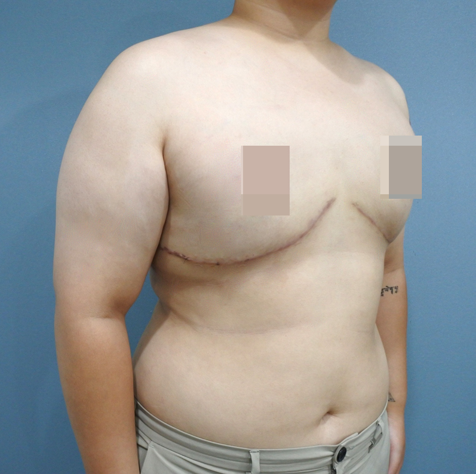 平胸手術,縮胸,楊氏羅丹,楊氏診所,台中羅丹,詹永璨醫師,醫美,胸部整形5