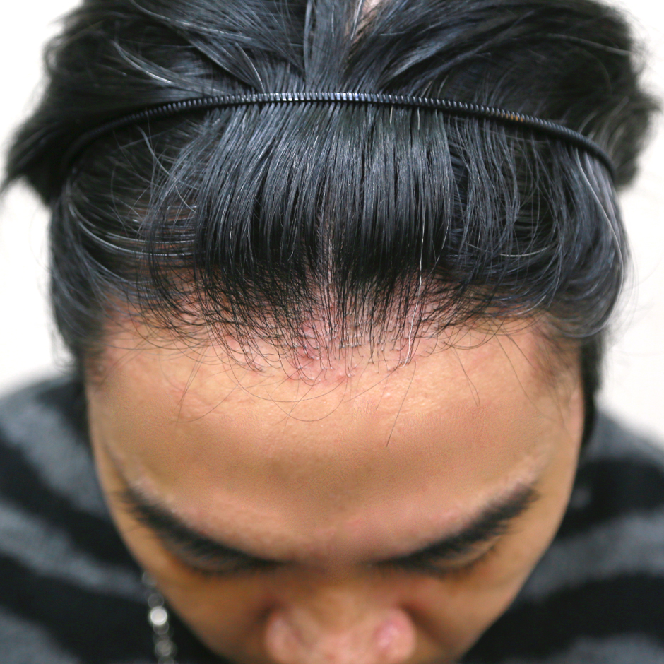 林鴻鳴,植髮,植髮手術,李定懋,台北植髮,楊氏羅丹,羅丹診所,掉髮,落髮,禿頭,雄性禿