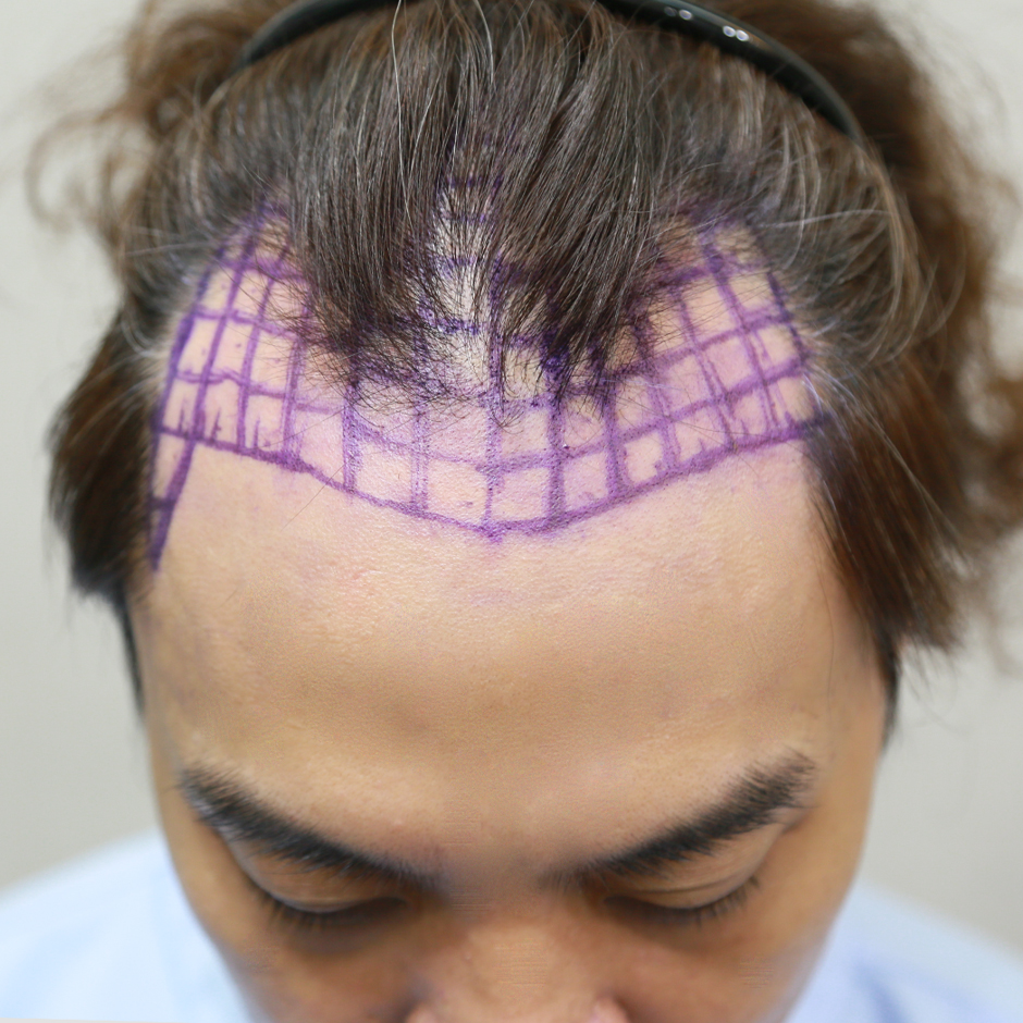 林鴻鳴,植髮,植髮手術,李定懋,台北植髮,楊氏羅丹,羅丹診所,掉髮,落髮,禿頭,雄性禿