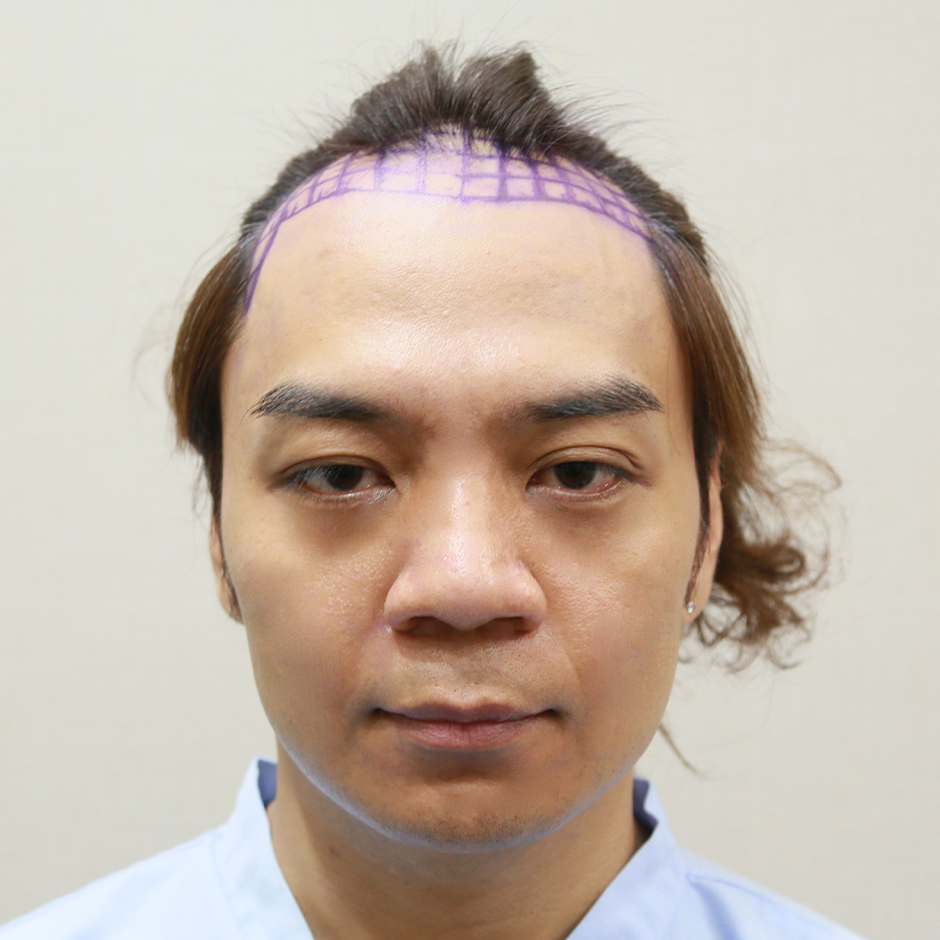 林鴻鳴,植髮,植髮手術,李定懋,台北植髮,楊氏羅丹,羅丹診所,掉髮,落髮,禿頭,雄性禿