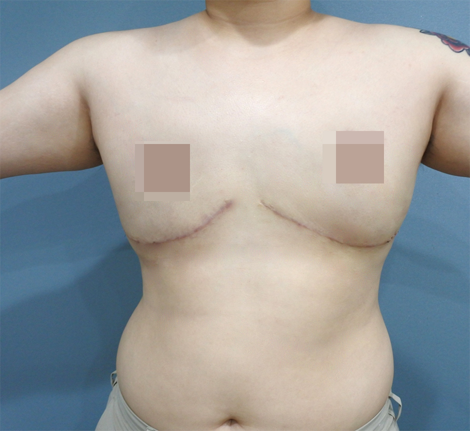 平胸手術,縮胸,楊氏羅丹,楊氏診所,台中羅丹,詹永璨醫師,醫美,胸部整形5