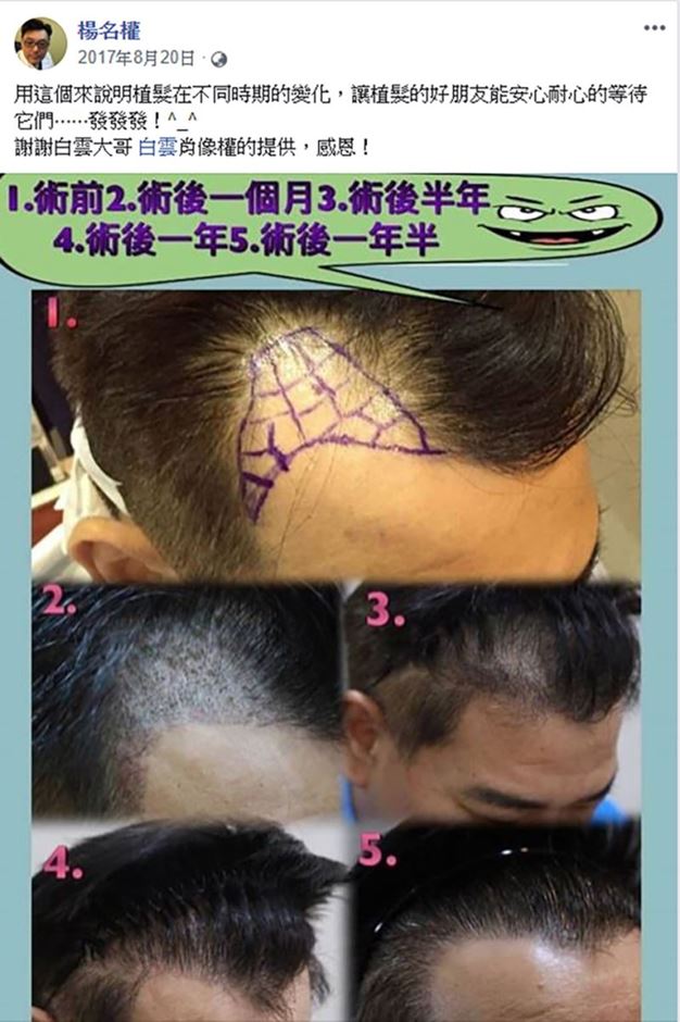 白雲,楊名權,楊氏羅丹,六合一三階段雄性禿治療