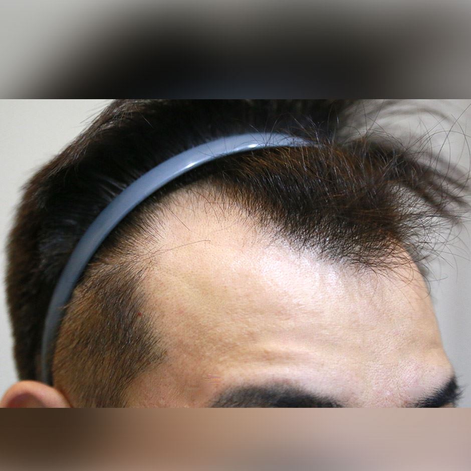 植髮,雄性禿,楊氏羅丹,台北植髮,植鬍,植眉,圓禿,掉髮,落髮,楊名權,李定懋