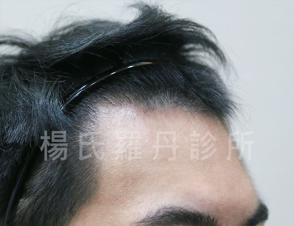 植髮,雄性禿,楊氏羅丹,台北植髮,植鬍,植眉,圓禿,掉髮,落髮,楊名權,李定懋
