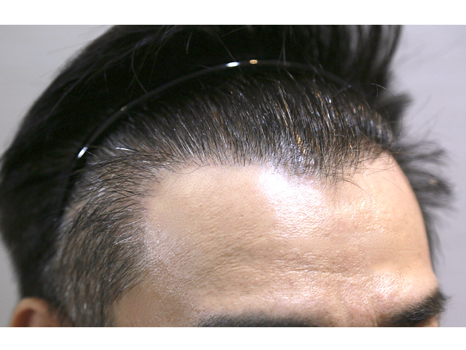 植髮,雄性禿,楊氏羅丹,台北植髮,植鬍,植眉,圓禿,掉髮,落髮,楊名權,李定懋