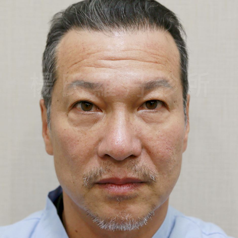 植髮,雄性禿,楊氏羅丹,台北植髮,植鬍,植眉,圓禿,掉髮,落髮,楊名權,李定懋