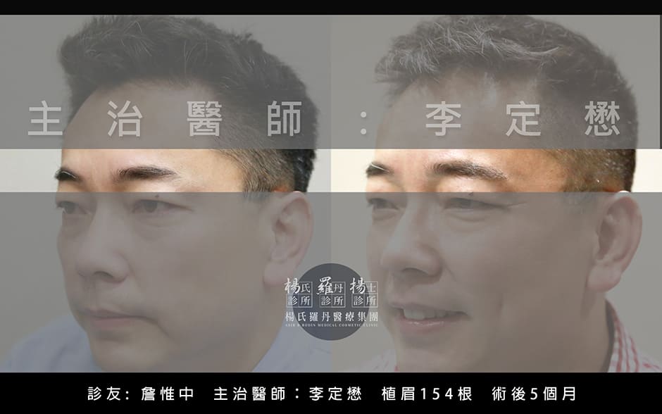 雄性禿,楊氏羅丹,台北植髮,植鬍,植眉,圓禿,掉髮,落髮,楊名權,李定懋