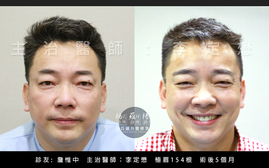 雄性禿,楊氏羅丹,台北植髮,植鬍,植眉,圓禿,掉髮,落髮,楊名權