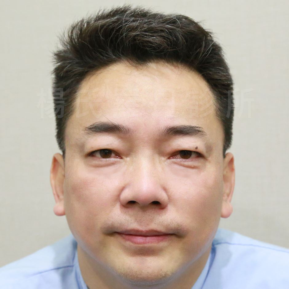 雄性禿,楊氏羅丹,台北植髮,植鬍,植眉,圓禿,掉髮,落髮,楊名權