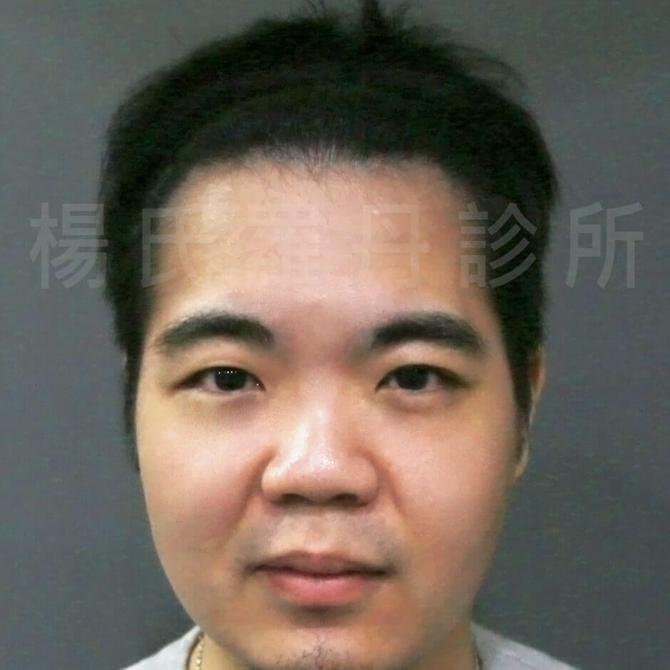 植髮,李定懋,楊名權,楊氏羅丹,楊氏羅丹植髮,台北植髮,禿頭,雄性禿,M字禿,落髮