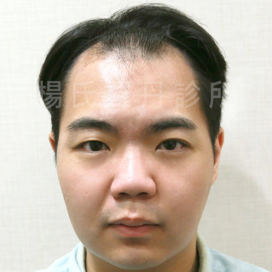 植髮,李定懋,楊名權,楊氏羅丹,楊氏羅丹植髮,台北植髮,禿頭,M字禿,落髮