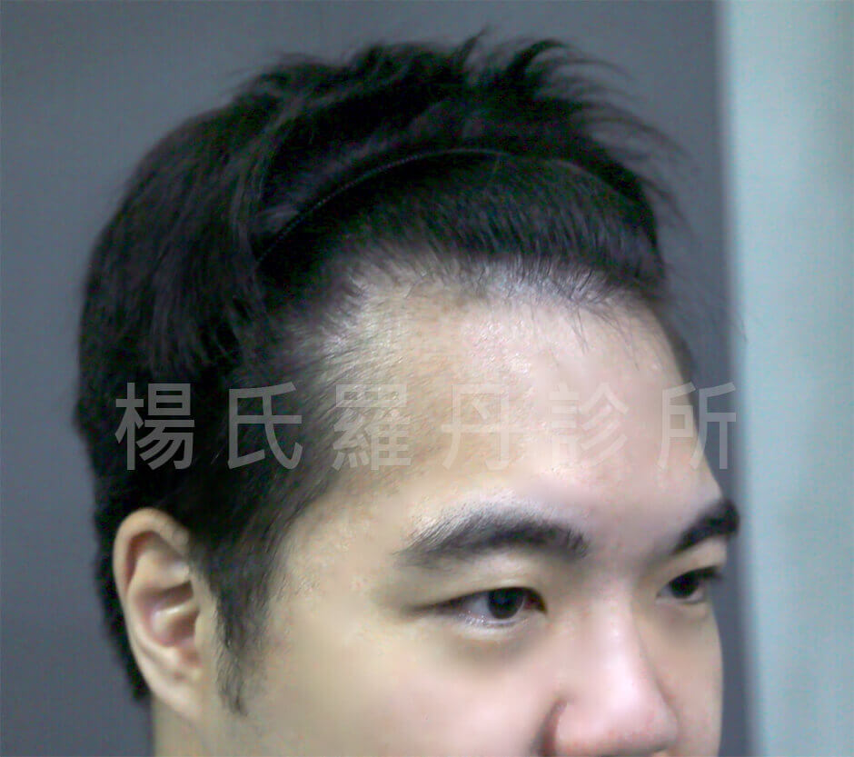 植髮,李定懋,楊名權,楊氏羅丹,楊氏羅丹植髮,台北植髮,禿頭,雄性禿,M字禿,落髮