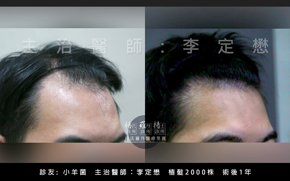 植髮,李定懋,楊名權,楊氏羅丹,楊氏羅丹植髮,台北植髮,禿頭,雄性禿,M字禿,落髮
