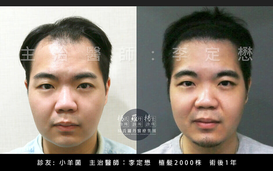 植髮,李定懋,楊名權,楊氏羅丹,楊氏羅丹植髮,台北植髮,禿頭,雄性禿,M字禿,落髮